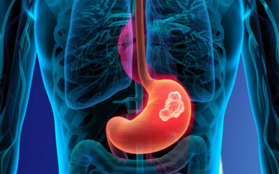 Στρωματικοί Όγκοι (Gist) Στομάχου