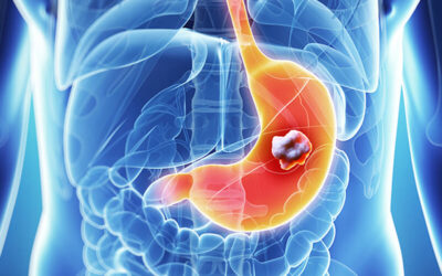 Καρκίνος Στομάχου