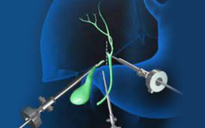 Χολοκυστεκτομή