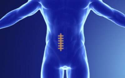 Μετεγχειρητική Κήλη